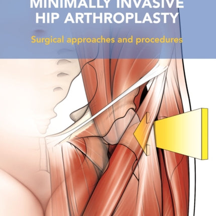 Minimally Invasive Hip Arthroplasty