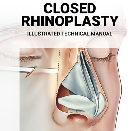 Closed Rhinoplasty