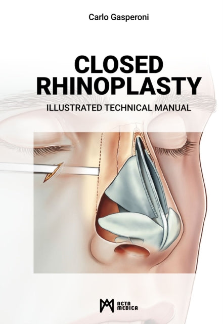 Closed Rhinoplasty