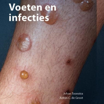 Voeten En Infecties