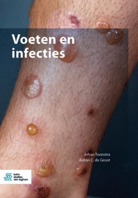 Voeten En Infecties