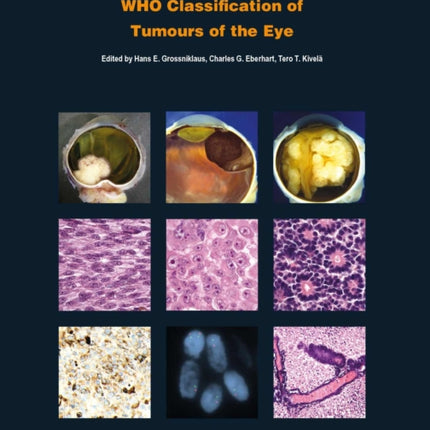 WHO Classification of Tumours of the Eye: WHO Classification of Tumours, Volume 12