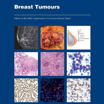 WHO Classification of Breast Tumours: WHO Classification of Tumours, Volume 2