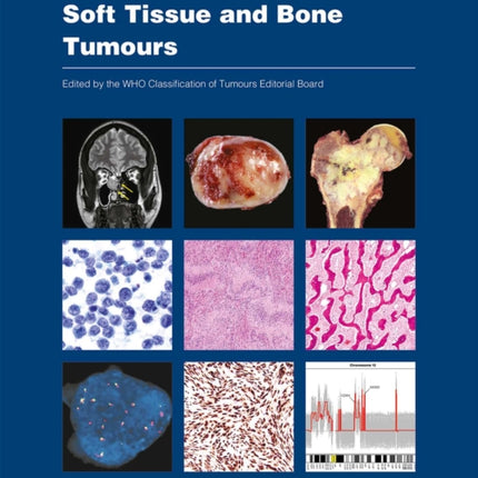 WHO classification of tumours of soft tissue and bone tumours