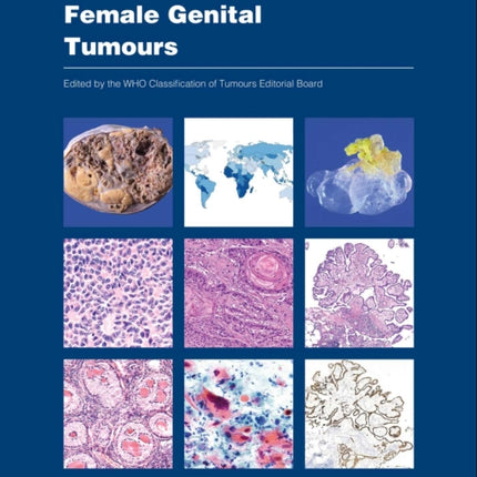 WHO classification of female genital tumours