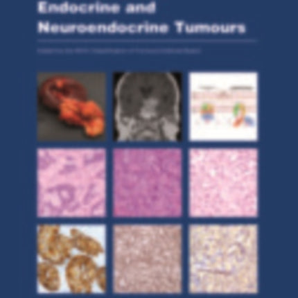 Endocrine and Neuroendocrine Tumours