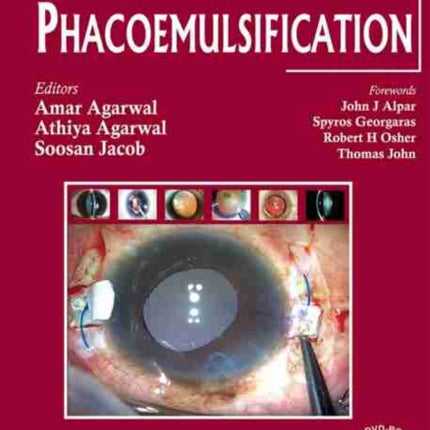 Phacoemulsification, Fourth Edition