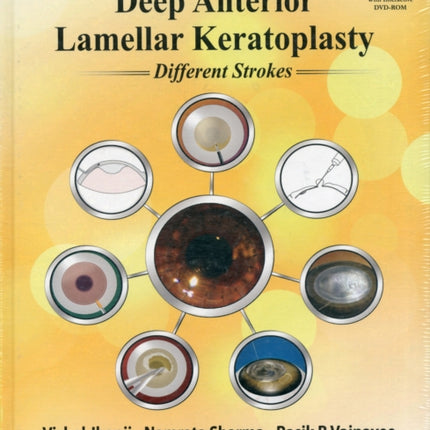 Deep Anterior Lamellar Keratoplasty Different Strokes