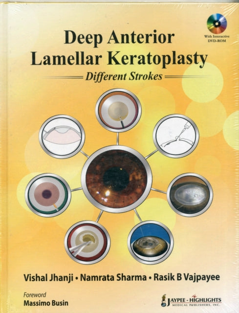 Deep Anterior Lamellar Keratoplasty Different Strokes