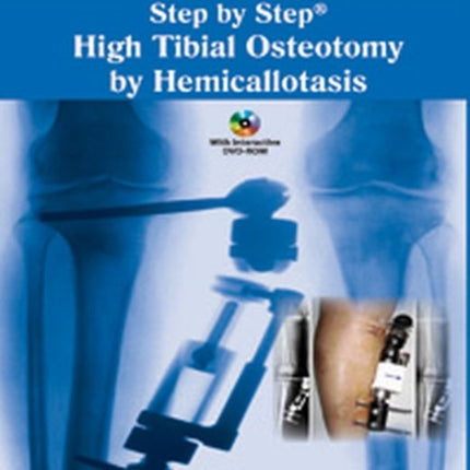 Step by Step High Tibial Osteotomy by Hemicallotasis