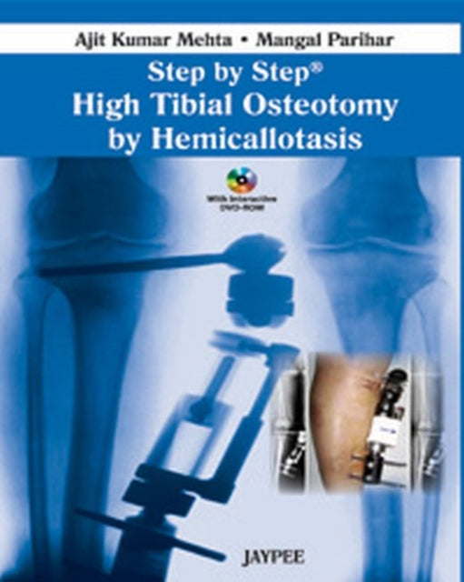 Step by Step High Tibial Osteotomy by Hemicallotasis