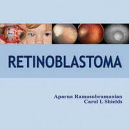 Retinoblastoma