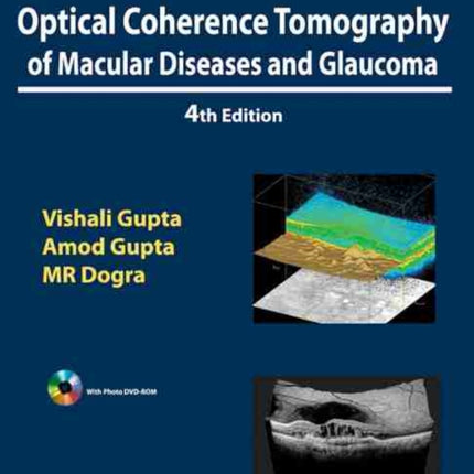 Atlas Optical Coherence Tomography of Macular Diseases and Glaucoma