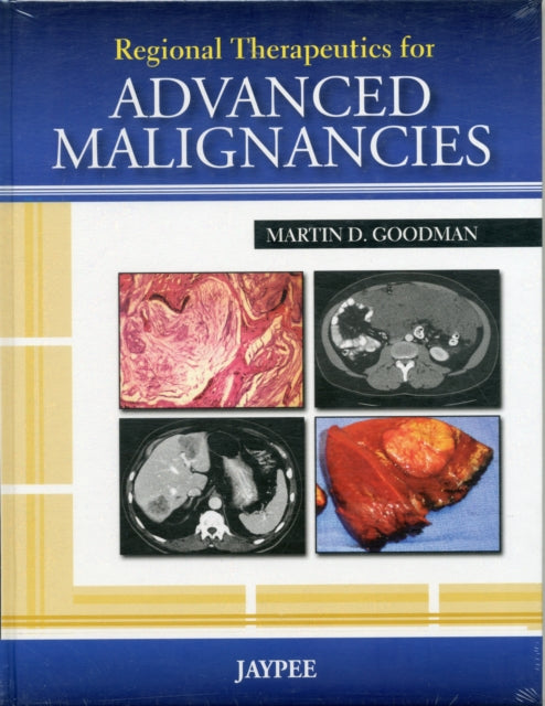 Regional Therapeutics for Advanced Malignancies