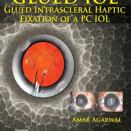 GLUED IOL: Glued Intrascleral Haptic Fixation of a PC IOL