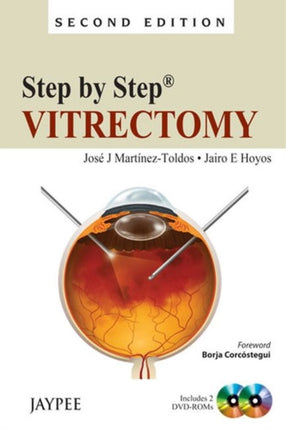 Step by Step: Vitrectomy