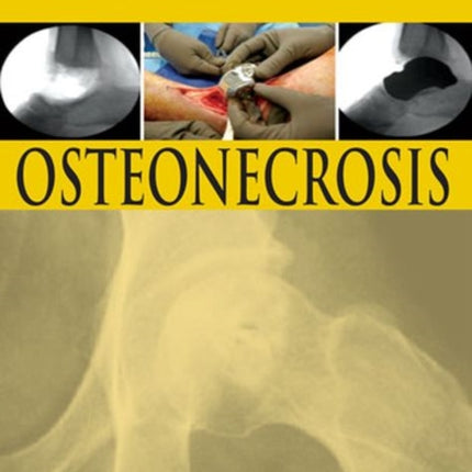 Osteonecrosis