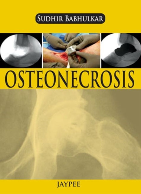 Osteonecrosis