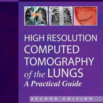 High Resolution Computed Tomography of the Lungs: A Practical Guide