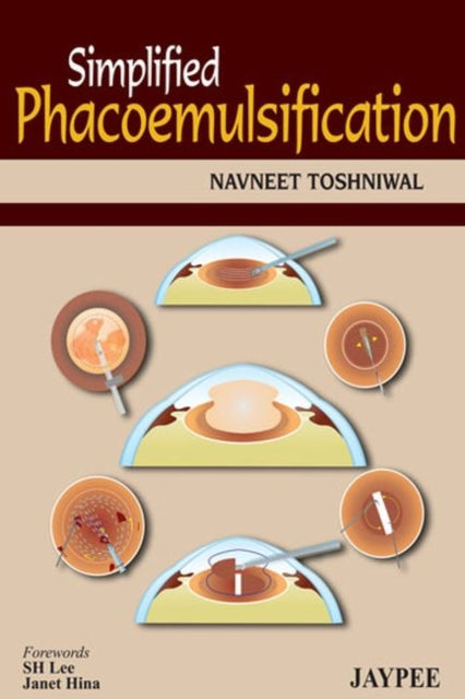 Simplified Phacoemulsification