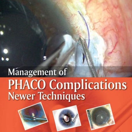 Management of Phaco Complications: Newer Techniques