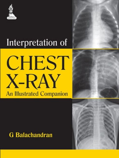 Interpretation of Chest X-Ray: An Illustrated