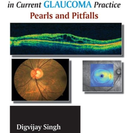 Optical Coherence Tomography in Current Glaucoma Practice: Pearls and Pitfalls