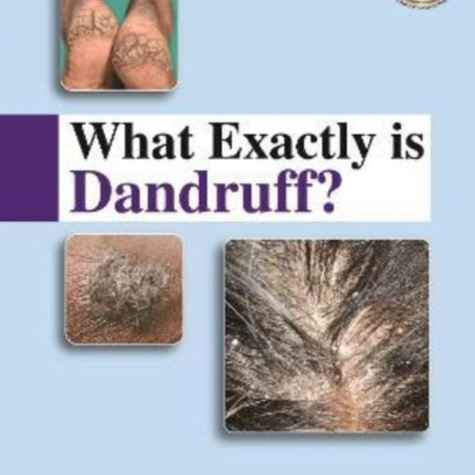 What Exactly is Dandruff?
