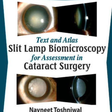 Text and Atlas: Slit Lamp Biomicroscopy for Assessment in Cataract Surgery