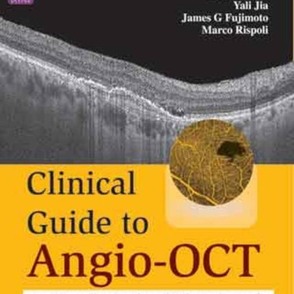 Clinical Guide to Angio-OCT: Non Invasive, Dyeless OCT Angiography