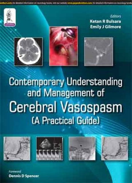 Contemporary Understanding and Management of Cerebral Vasospasm