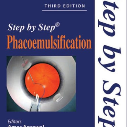 Step by Step Phacoemulsification