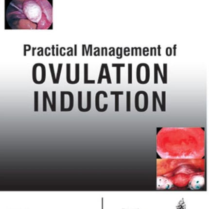 Practical Management of Ovulation Induction