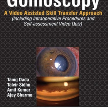 Gonioscopy: A Video Assisted Skill Transfer Approach