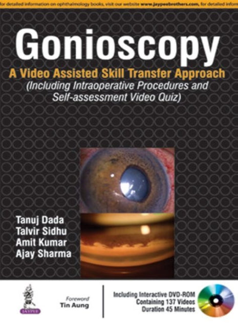 Gonioscopy: A Video Assisted Skill Transfer Approach