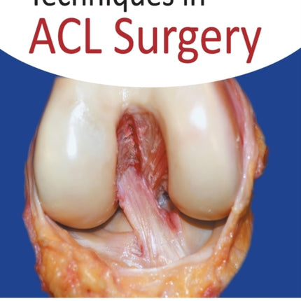 Techniques in ACL Surgery