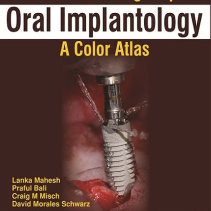 Treatment Planning Steps in Oral Implantology: A Color Atlas