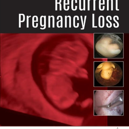 Recurrent Pregnancy Loss