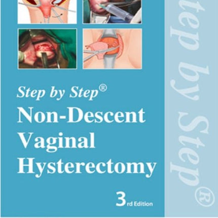 Step by Step: Non-Descent Vaginal Hysterectomy