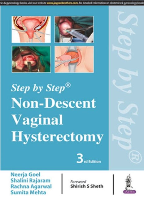 Step by Step: Non-Descent Vaginal Hysterectomy