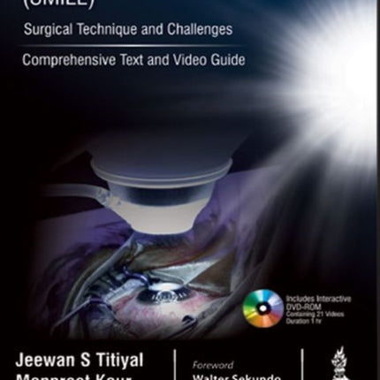 Small Incision Lenticule Extraction (SMILE): Surgical Technique and Challenges: Comprehensive Text and Video Guide