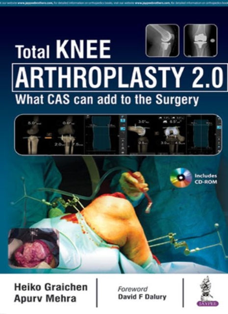 Total Knee Arthroplasty 2.0: What CAS can add to
