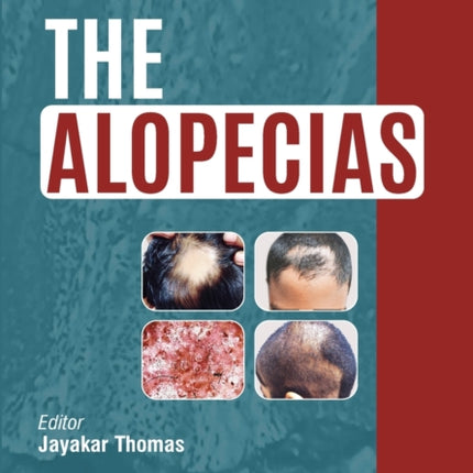 The Alopecias