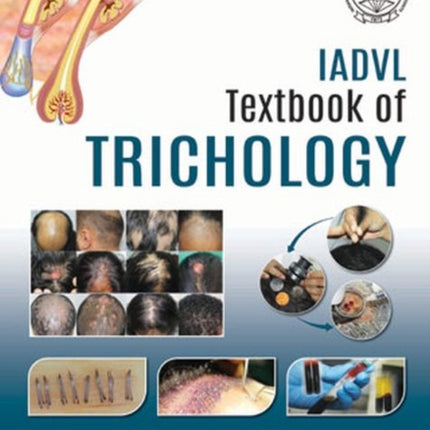 IADVL Textbook of Trichology