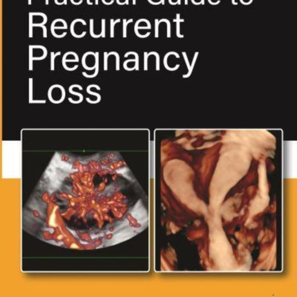 Practical Guide to Recurrent Pregnancy Loss