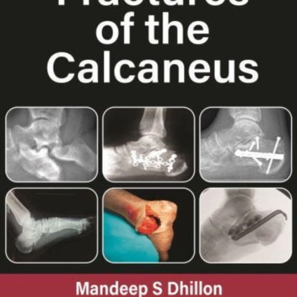 Fractures of the Calcaneus