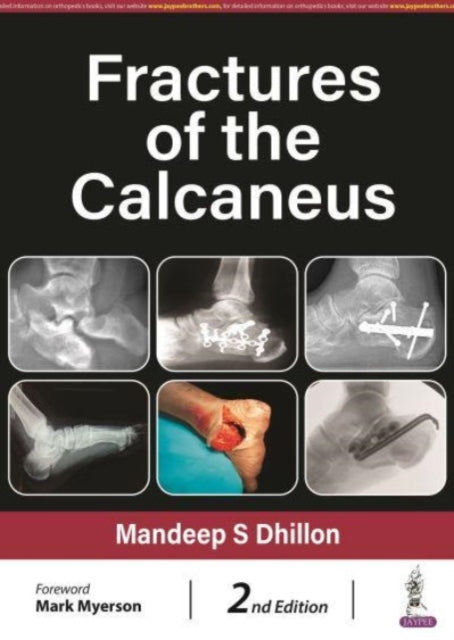 Fractures of the Calcaneus