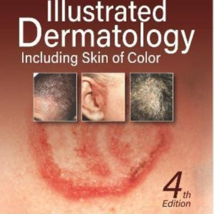 Illustrated Dermatology: Including Skin of Colour