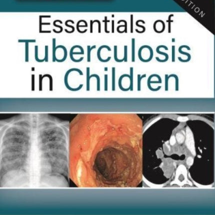 Essentials of Tuberculosis in Children