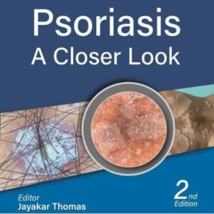 Psoriasis: A Closer Look